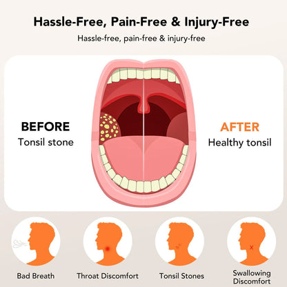 Sonease Tonsil Stones Cleaner